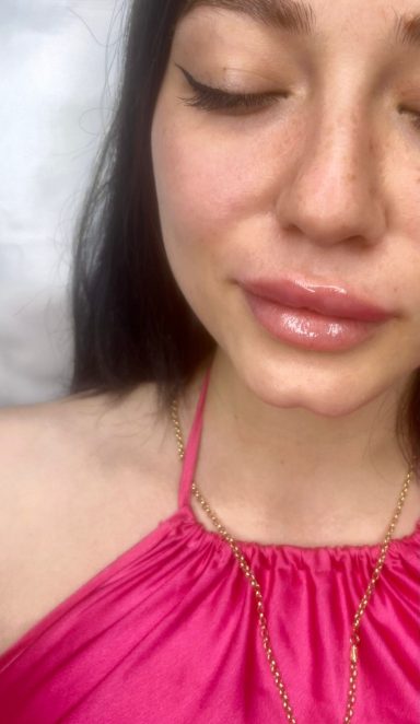                  Dermal Filler Injections              
